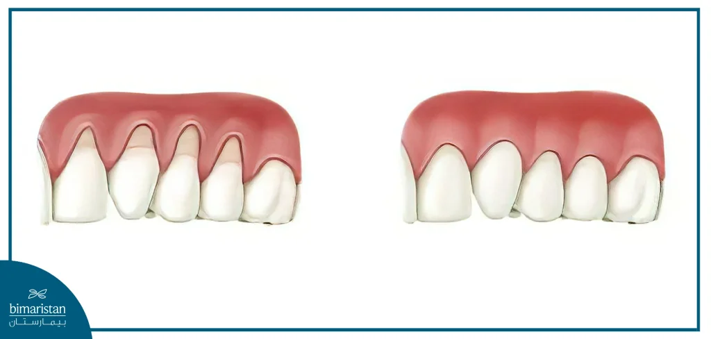 Covering The Place Of Receding Gums Using Gum Grafts In Istanbul