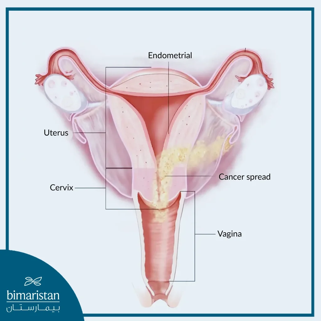 Cancer Spread In Cervical Cancer