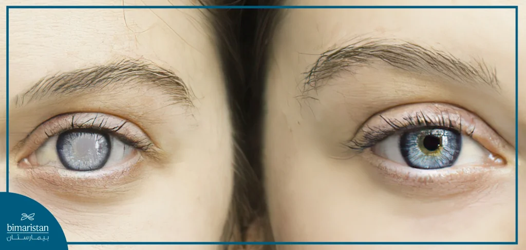 The Difference Between A Normal Eye And An Eye Affected This Disease