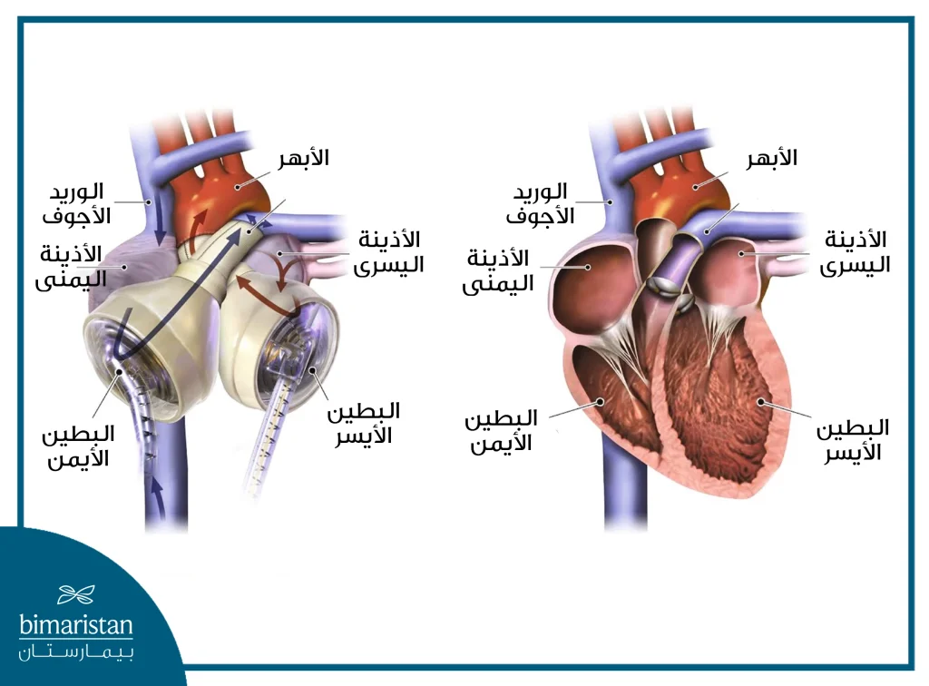 يحتوي القلب الصناعي على حجرتين تقابلان البطينين الأيمن والأيسر