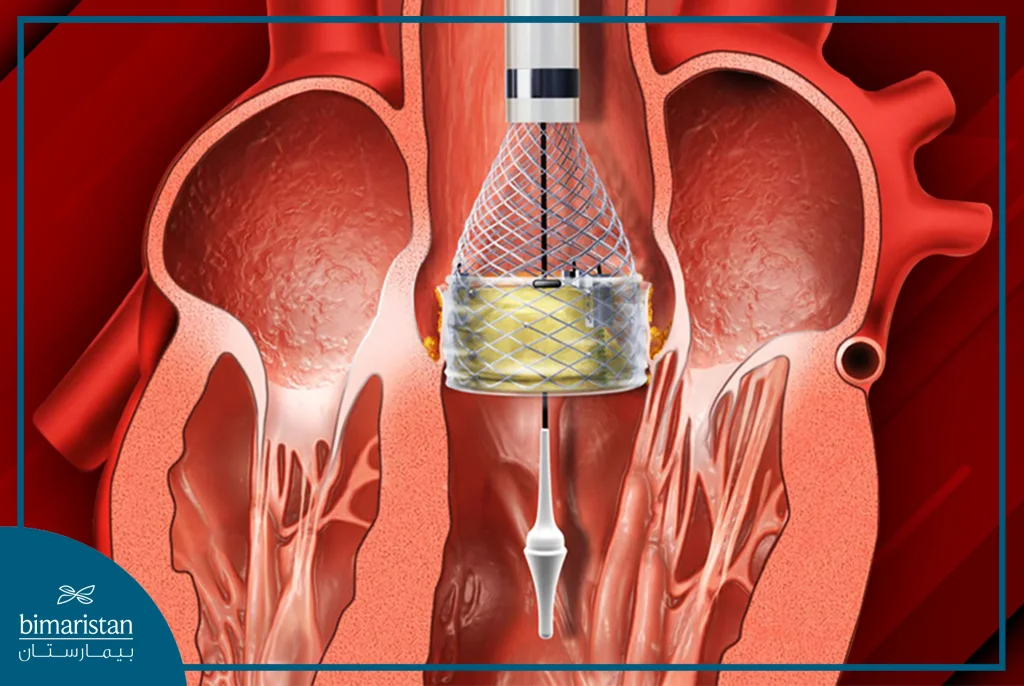 Image Of The Mechanism Of The New Aortic Valve