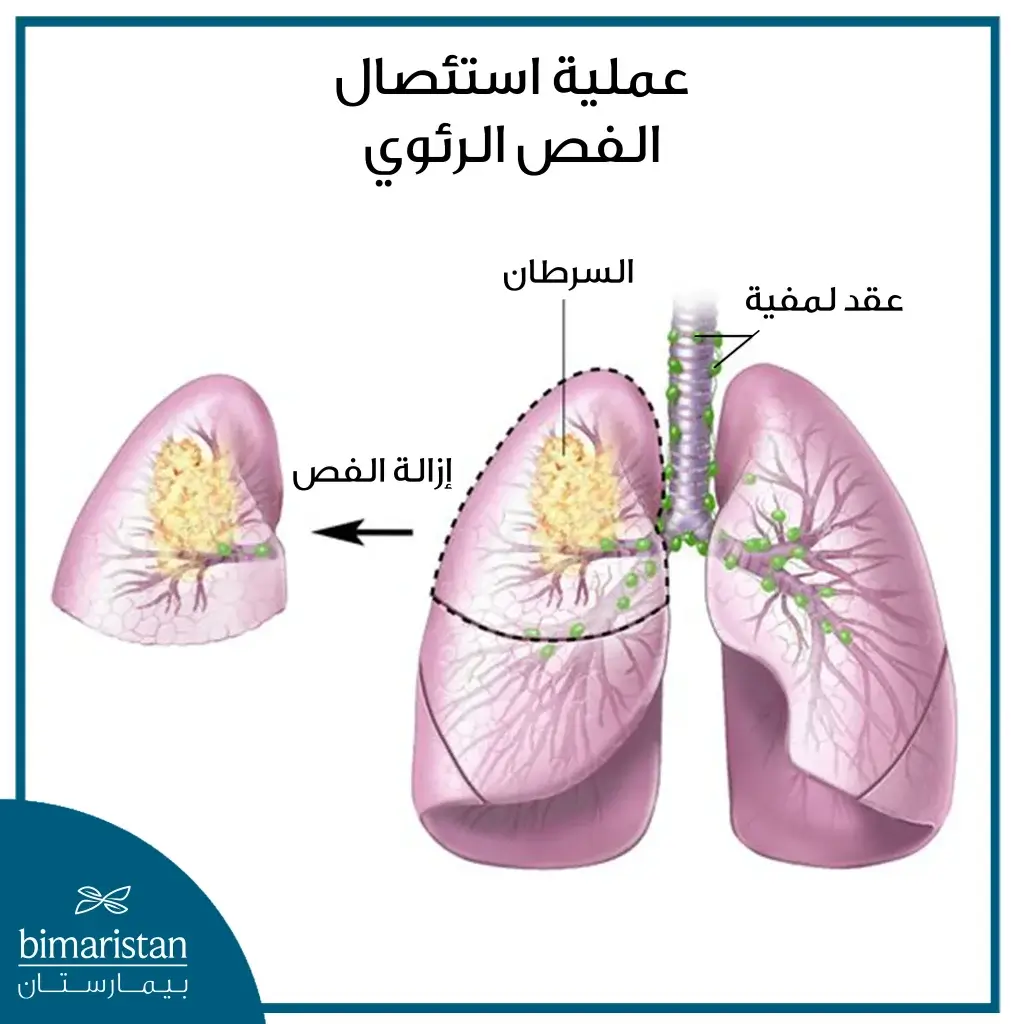 الدليل الشامل لجراحة الصدر 2 عملية استئصال الفص الرئوي من عمليات جراحة الصدر في تركيا