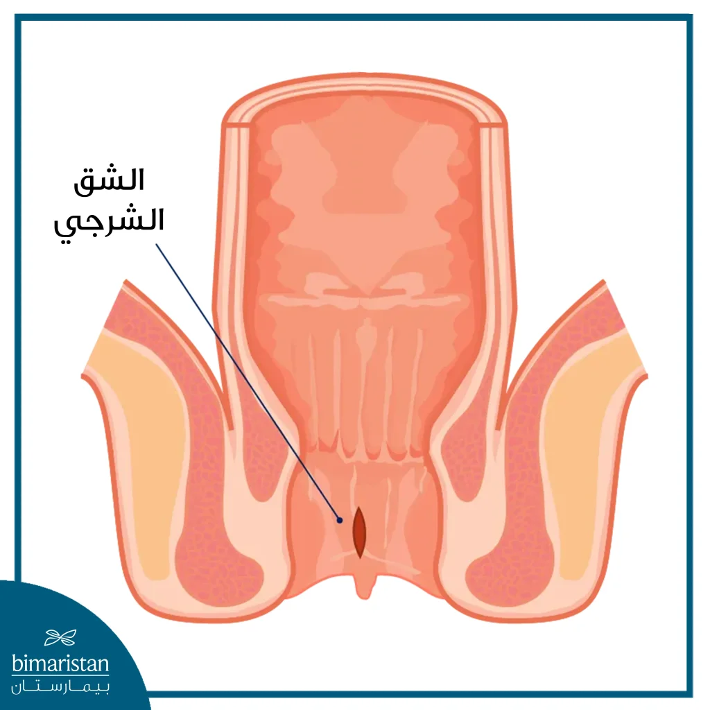 شكل الشق الشرجي