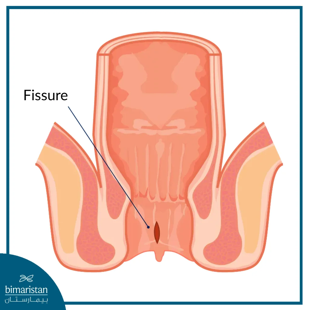 Shape Of Anal Fissure