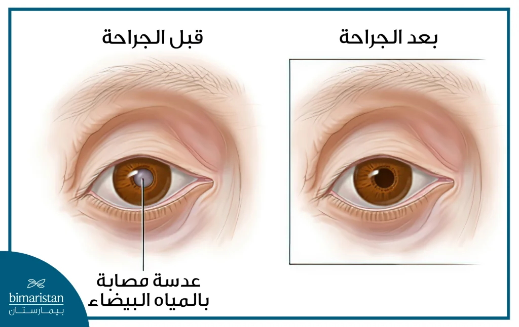 شكل العين بعد عملية المياه البيضاء