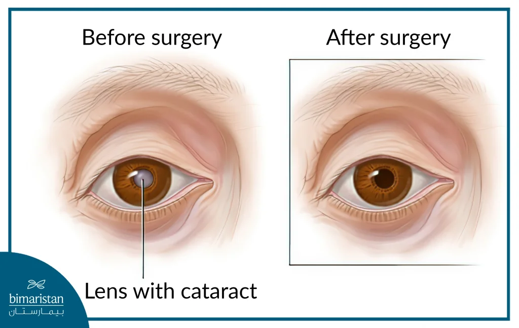 Eye Shape After Eye Cataract Surgery