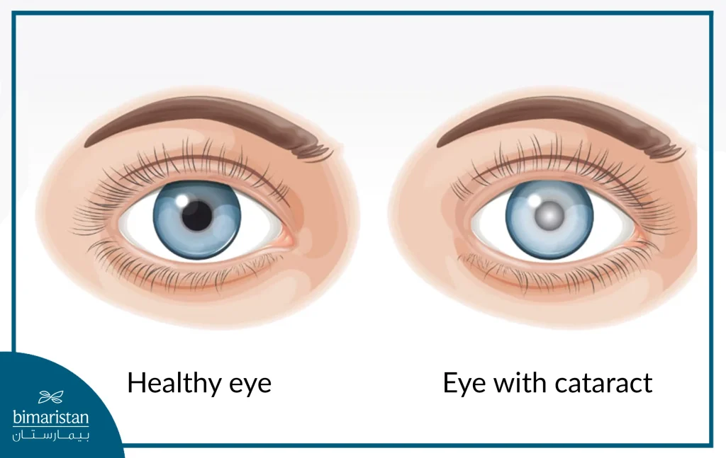 The Shape Of Eye Cataract