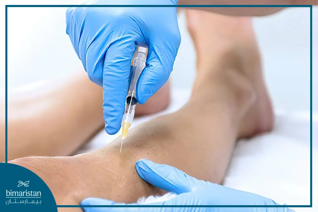 Varicose Veins Are Treated With Sclerotherapy By Injecting A Sclerosing Solution Into The Affected Vein, Causing It To Narrow.