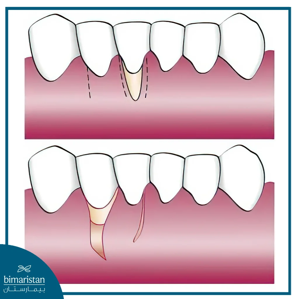 جراحة اللثة بتقنية الشريحة المزاحة جانبياً لتغطية الجذر المنكشف