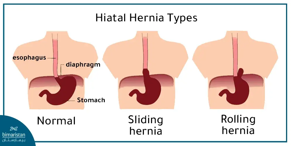 The Three Types Of Hiatal Hernia And What Happens In Each Type Of Hiatal Hernia