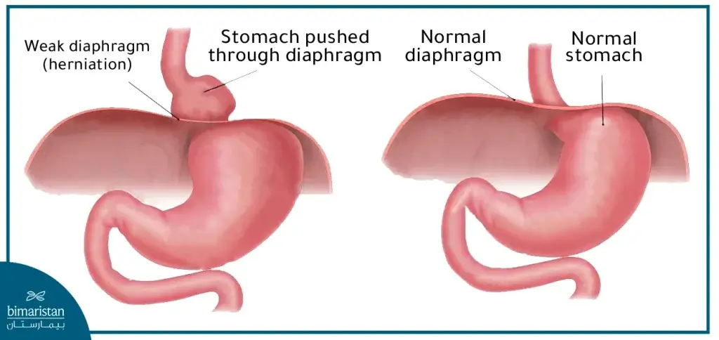 Comparison Between The Normal Condition And The Condition Of A Hiatal Hernia, Where The Herniated Diaphragm Rises Up Out Of Its Normal Position