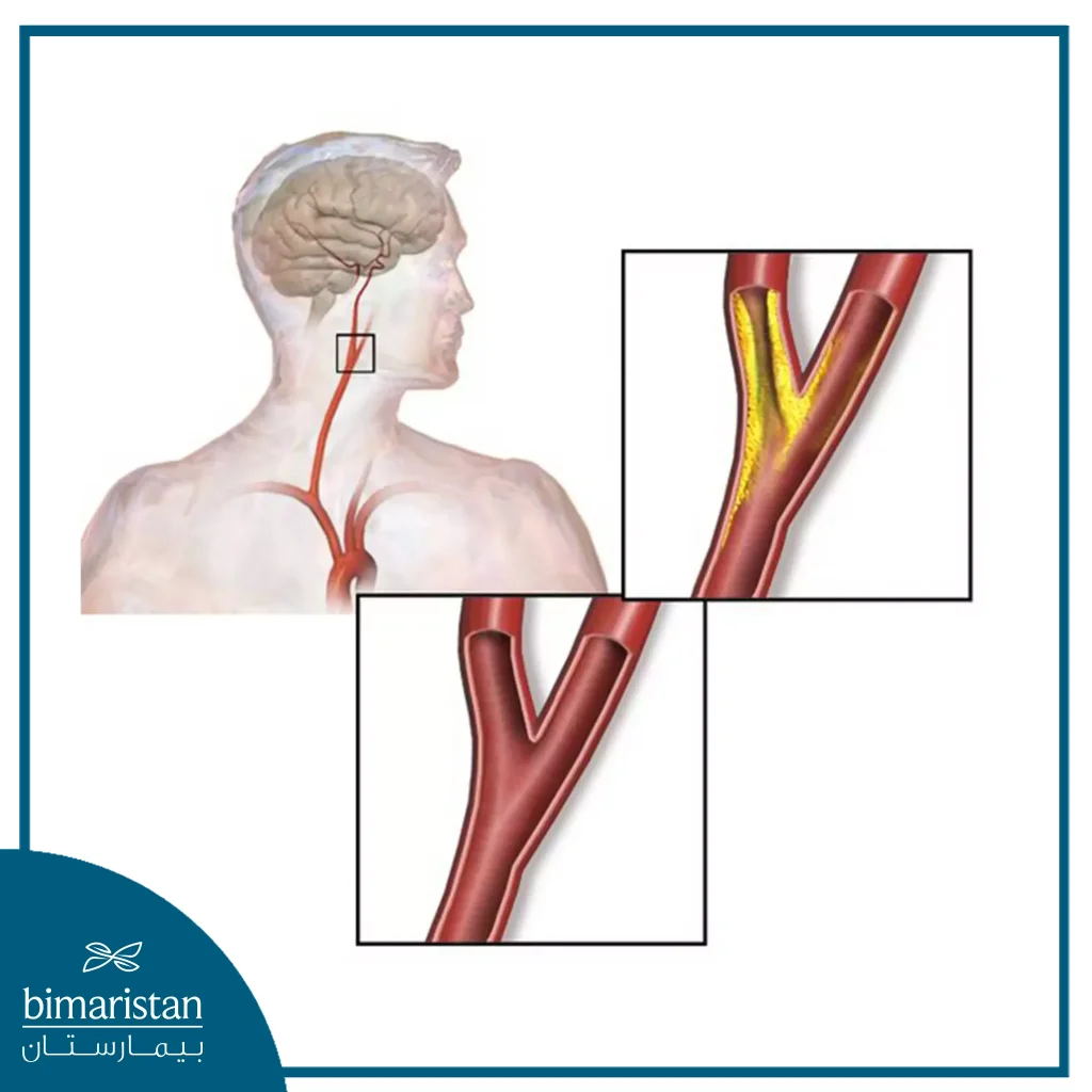 Many Factors, Such As High Cholesterol, Cause The Lumen Of The Carotid Artery To Narrow And Atherosclerotic Plaque To Form In The Artery Wall.