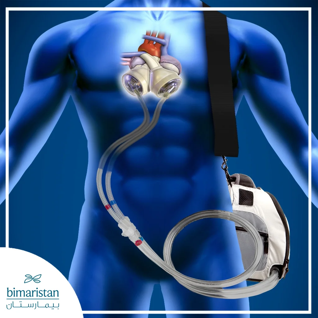 The Artificial Heart Is Placed In Place Of The Natural Heart In The Patient'S Chest And Is Connected Via Tubes To A Monitoring Device Outside The Body That The Patient Wears At All Times.