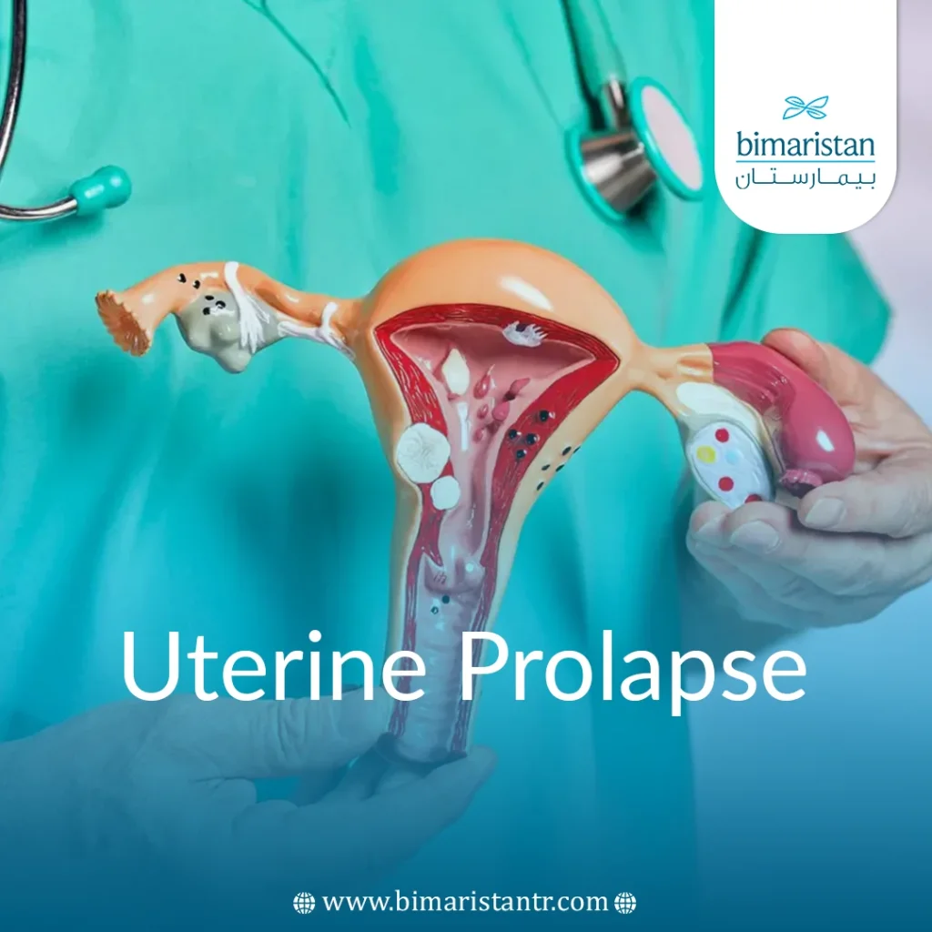 Uterine Prolapse Causes, Symptoms, and Treatment in Turkey, image size:1024x1024
