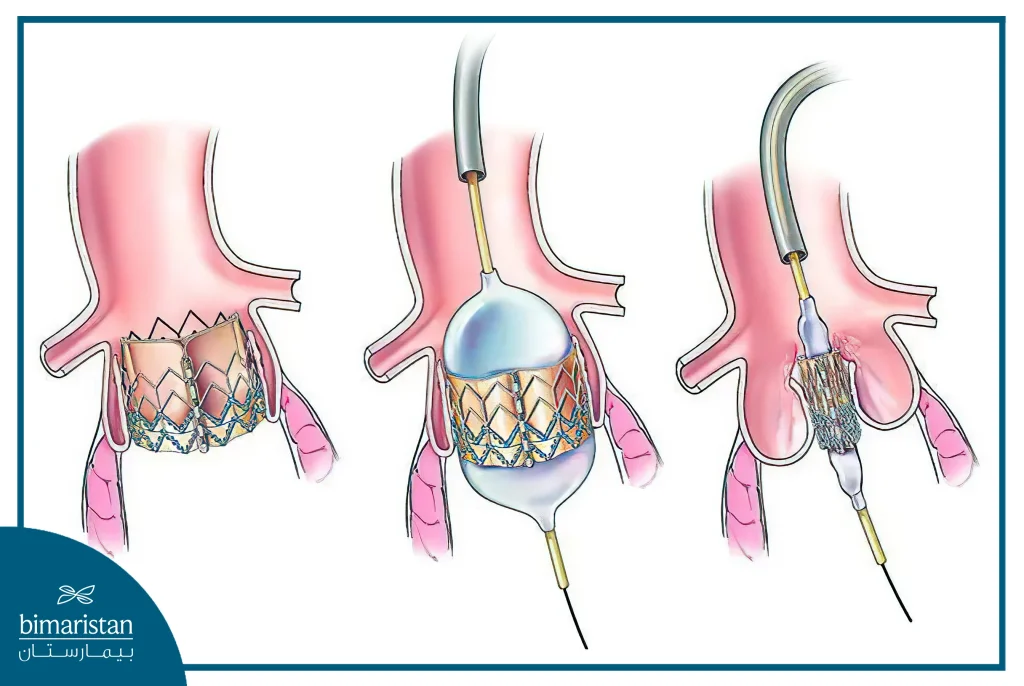 Image Showing The New Valve Placed Over The Old Valve In Aortic Valve Replacement