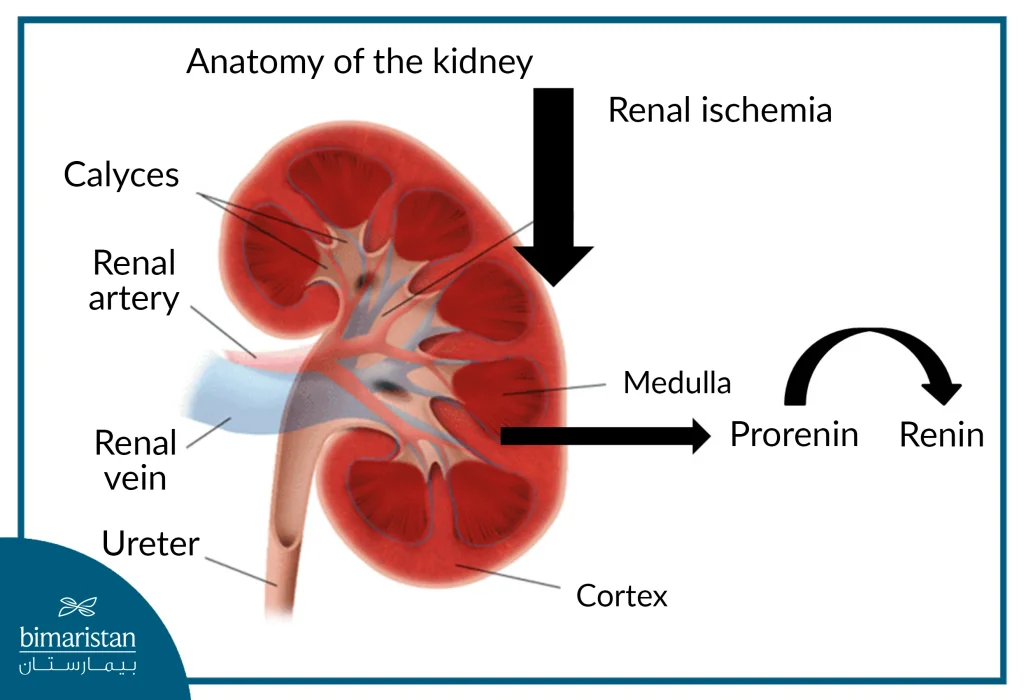 Renal Ischemia Caused By Renal Artery Stenosis Induces The Conversion Of Pre-Renin In The Kidney To Renin, Which Raises Blood Pressure