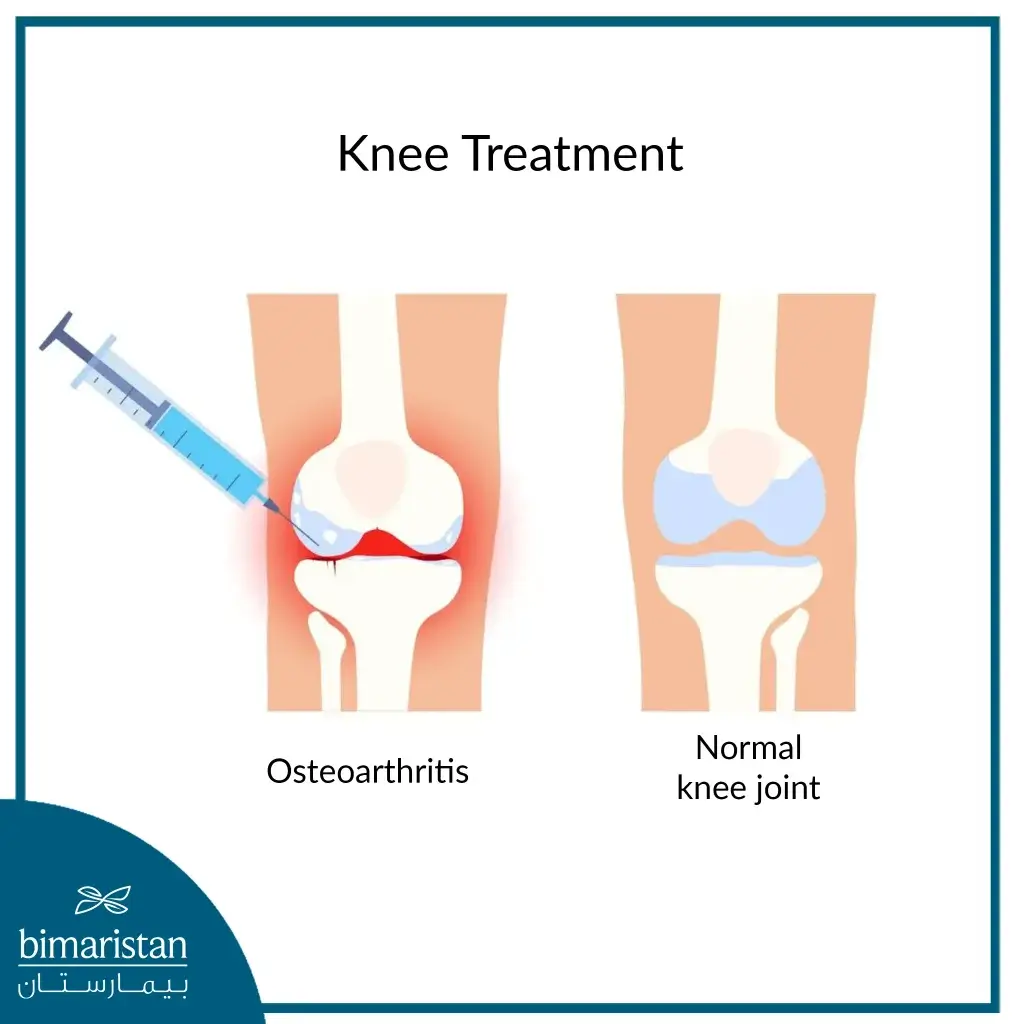 Injection Of Hyaluronic Acid To Treat Osteoarthritis