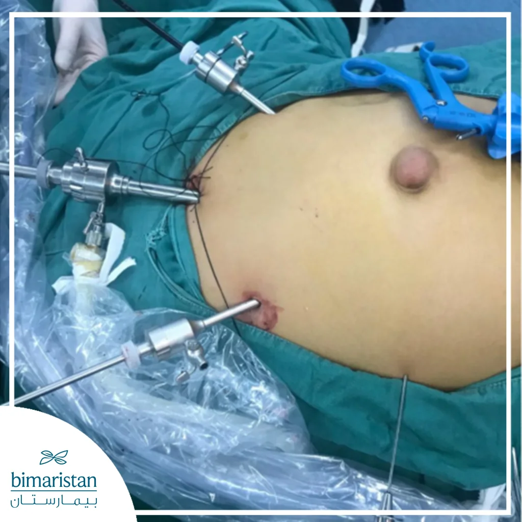 Image Showing Laparoscopic Surgery To Treat Umbilical Hernia In Women