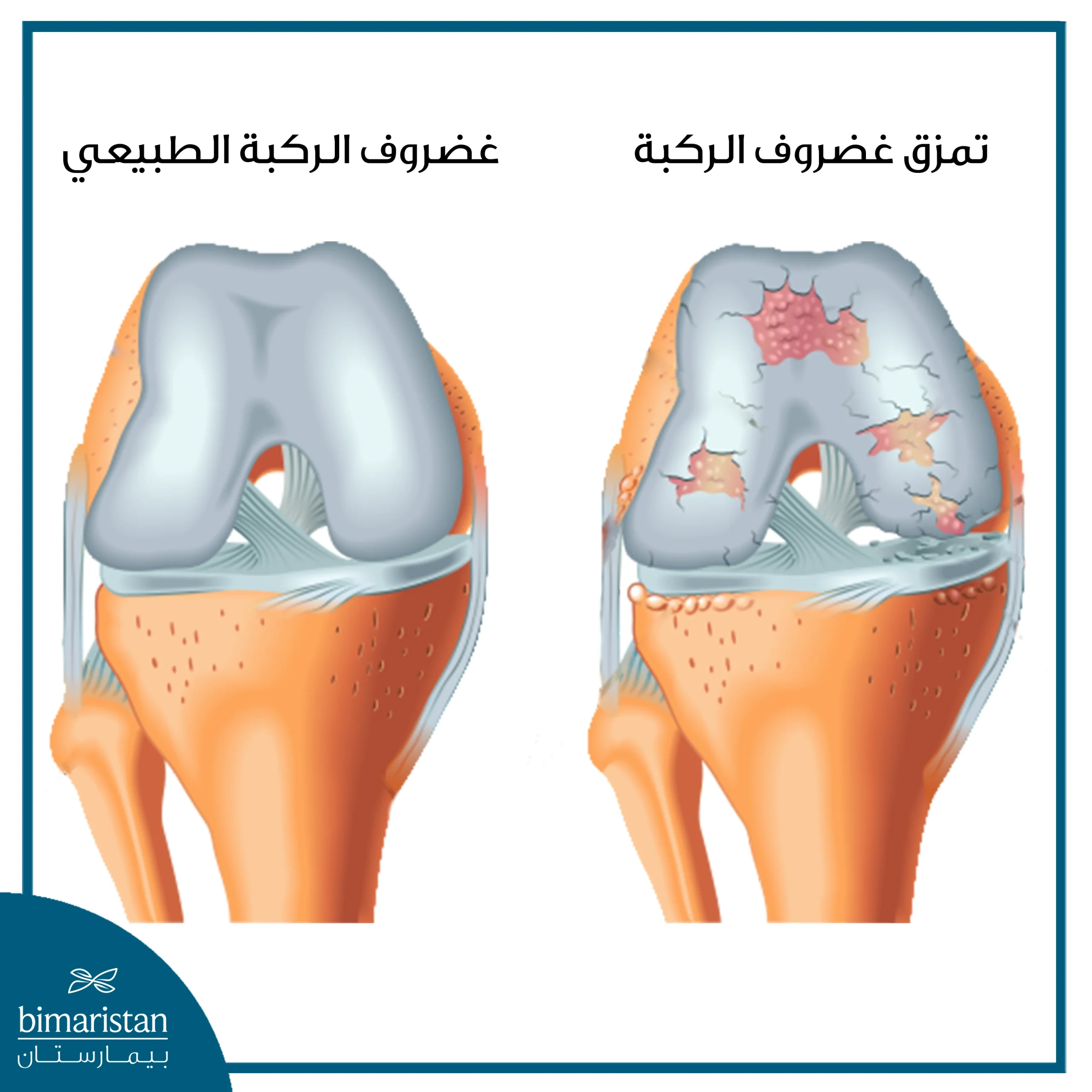 توضح هذه الصورة مقارنة بين الغضروف الطبيعي للركبة وغضروف متمزق يحتاج لإجراء عملية غضروف الركبة لإصلاحه