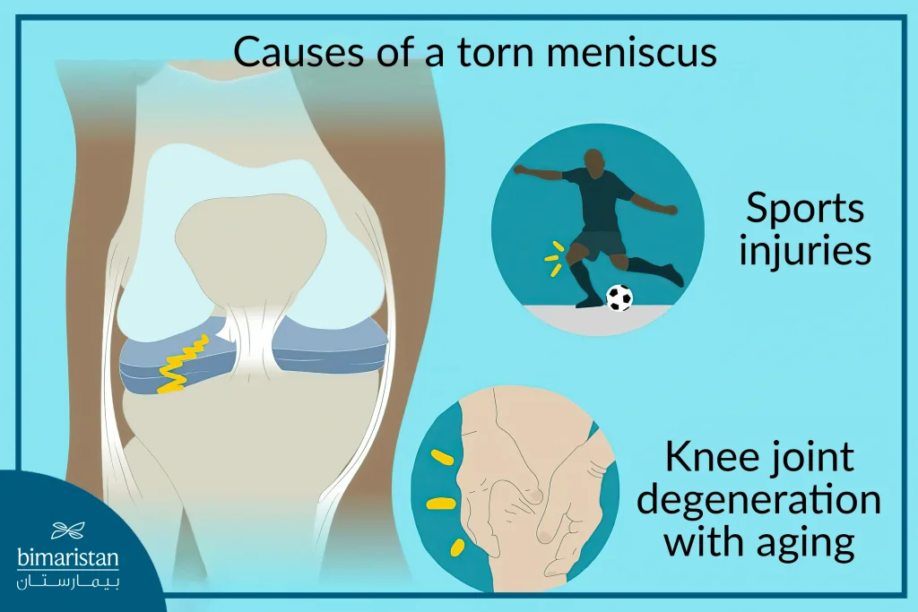 Causes Of Knee Cartilage Tear