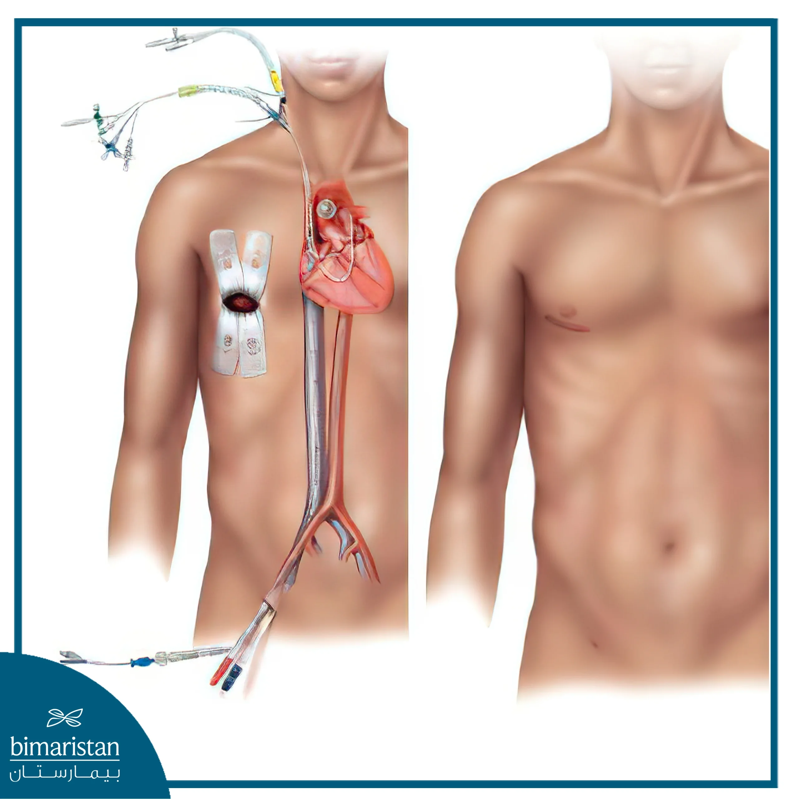 During And After Minimally Invasive Heart Surgery