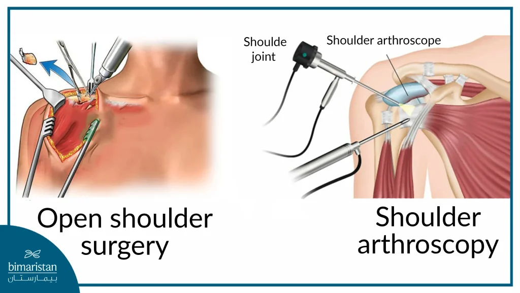 Open Surgery And Arthroscopy In Rotator Cuff Repair