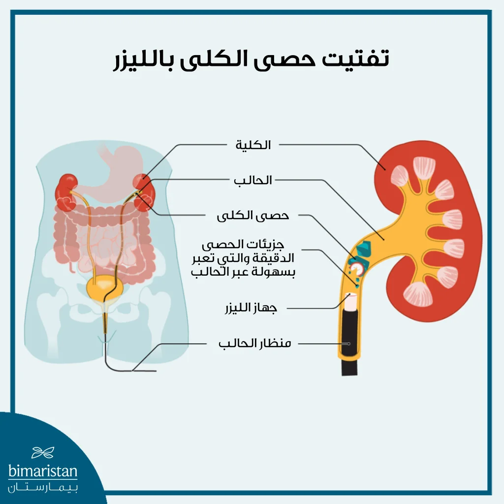 توضح هذه الصورة خطوات إجراء تفتيت حصى الكلى بالليزر والتي تتم بواسطة منظار الحالب