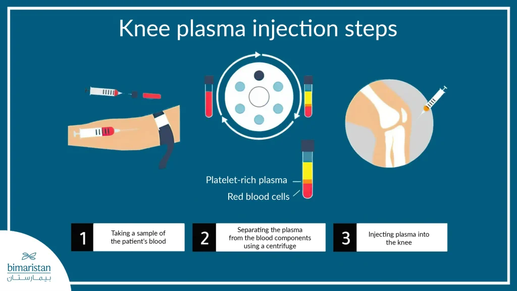 Knee Plasma Injection Steps