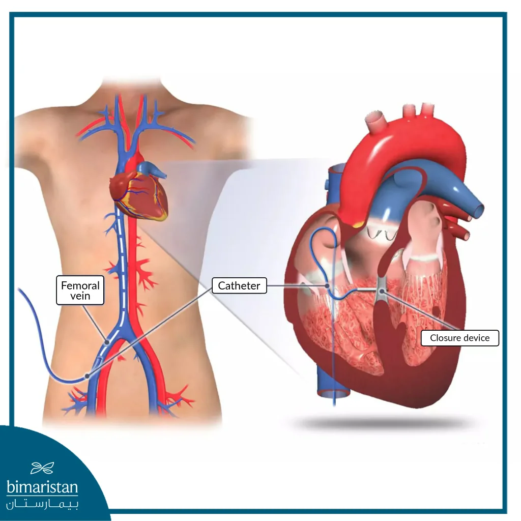 A Ventricular Septal Defect (Vsd) Is Repaired Via Catheterization By Delivering A Closure Device To Seal The Hole Between The Ventricles.