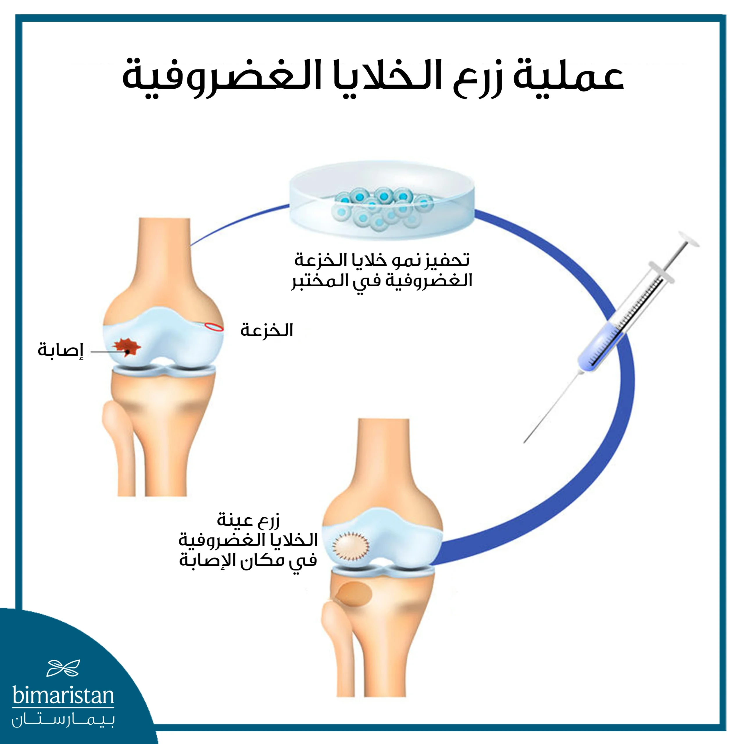 خطوات عملية غضروف الركبة عبر زرع خزعة من خلايا الغضروف المتضرر