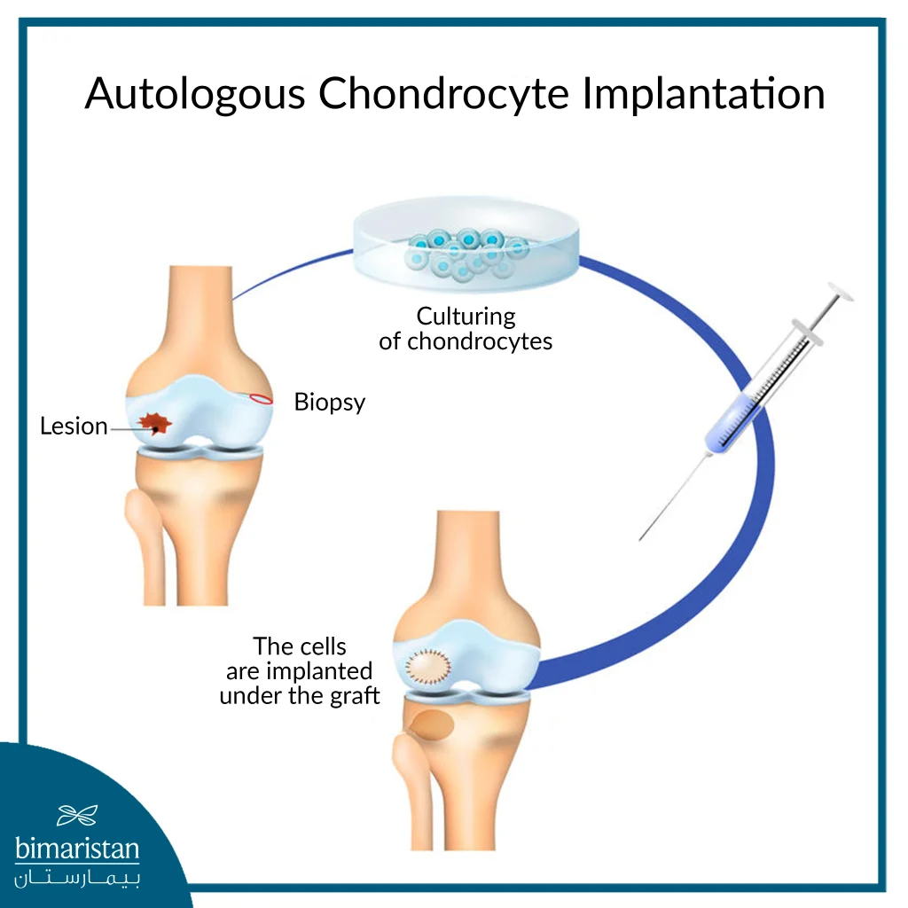 Steps Of Knee Cartilage Surgery Using A Biopsy Implant From The Damaged Cartilage