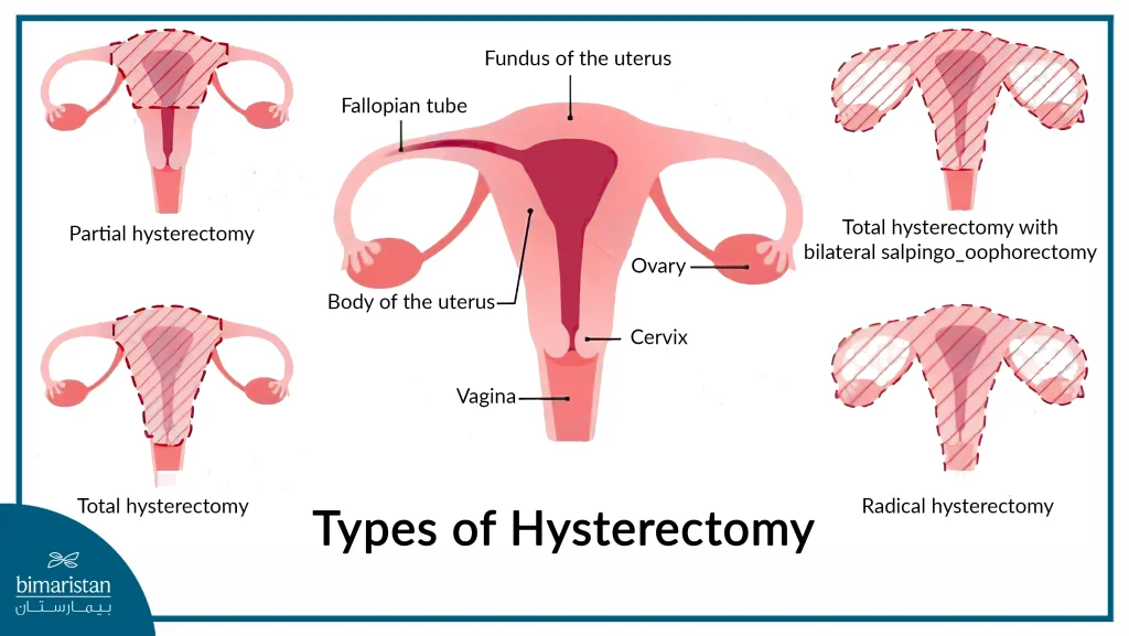 An Image Showing The Four Types Of Hysterectomy And What Is Removed In Each One. 