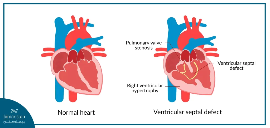 A Ventricular Septal Defect Is Characterized By A Hole Through Which Blood Passes, Potentially Accompanied By Pulmonary Valve Stenosis And Right Ventricular Hypertrophy.