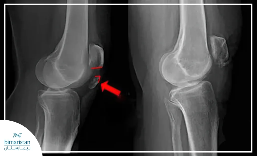 Knee Fractures X-Ray Imaging