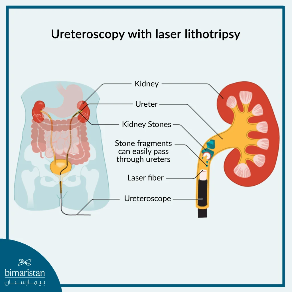 This Image Illustrates The Steps Of Laser Lithotripsy For Kidney Stones, Performed Using A Ureteroscope.
