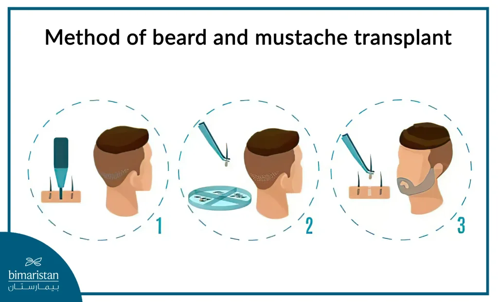 Steps For Performing A Beard And Mustache Transplant In Turkey&Quot;