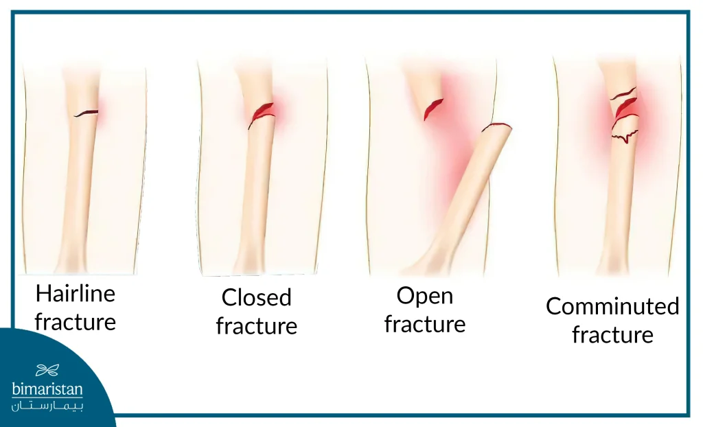 Knee Fractures Types