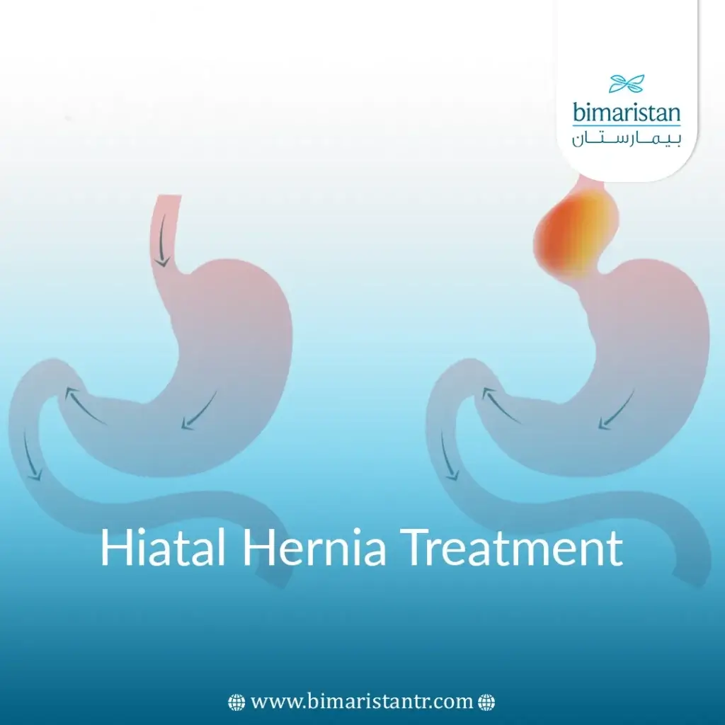 Hiatal Hernia Treatment In Turkey