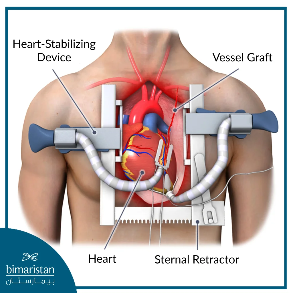 Some Coronary Artery Bypass Surgeries May Not Require The Use Of A Heart Pump