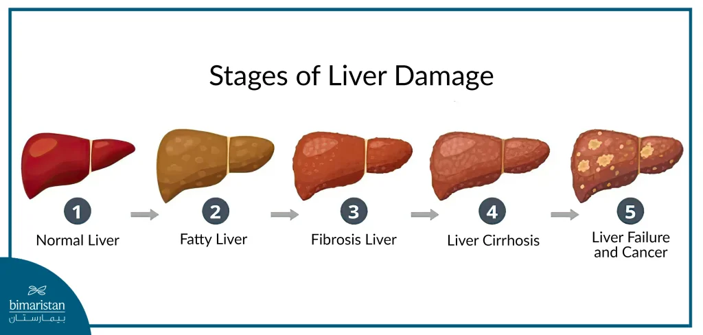 Image Showing The Stages Of Liver Damage That Require Treatment For Liver Fibrosis