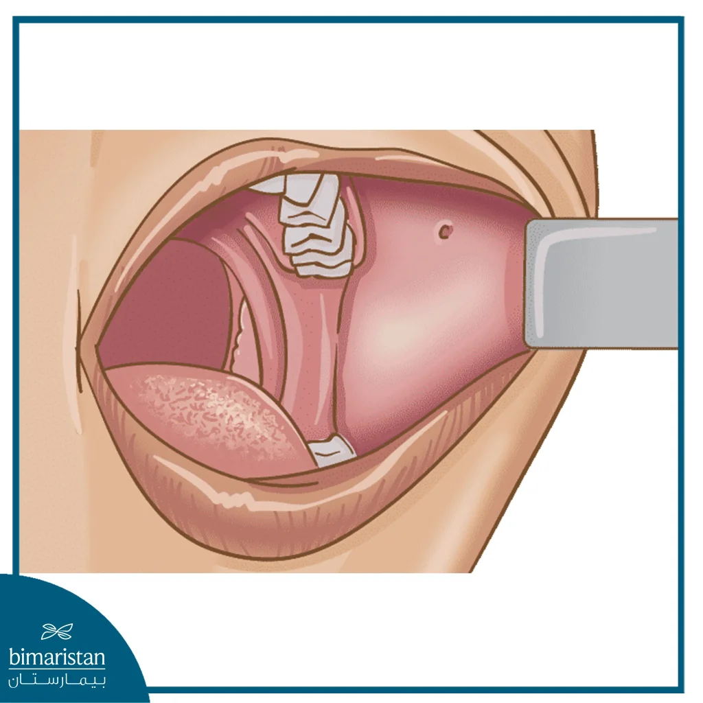 Oral Cancer Lesions On The Inner Cheek