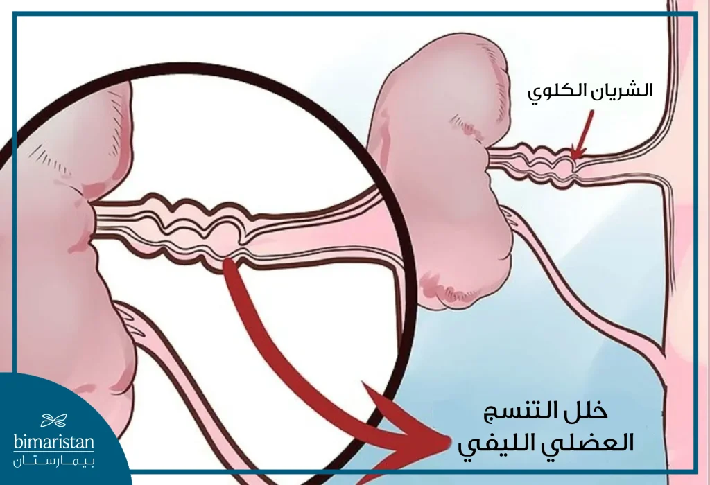 يؤدي خلل التنسج العضلي الليفي إلى تشوه لمعة الشريان وحدوث تضيق الشريان الكلوي