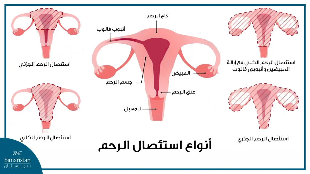 صورة تبين الأنواع الأربعة لعملية استئصال الرحم وماذا يُستأصل في كل واحدة منها