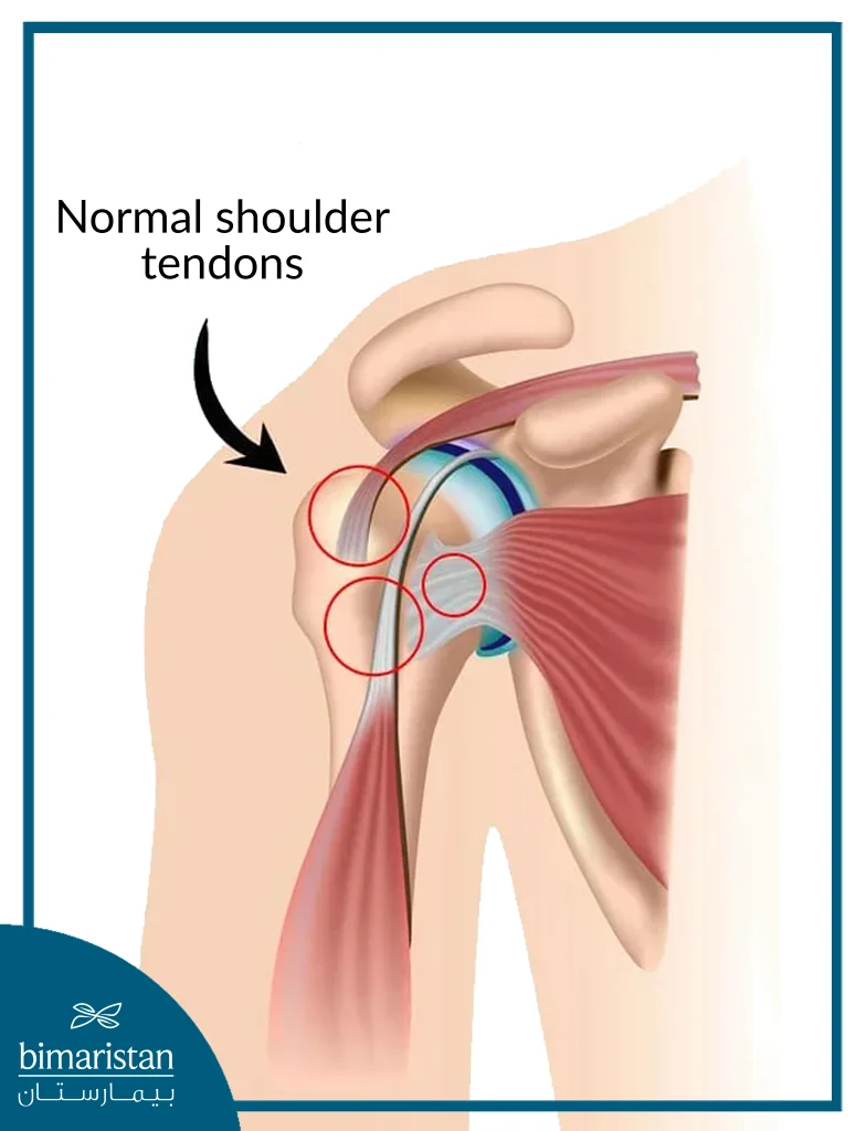 Image Of The Normal Shoulder Tendons, With Rotator Cuff Repair Surgery Performed When One Of Them Is Torn