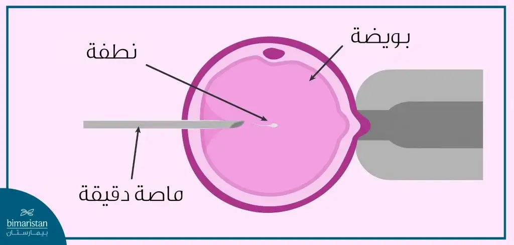 تقنية الحقن المجهري يتم فيها إدخال نطفة واحدة مباشرة بالبوبضة.