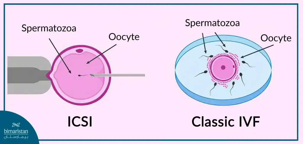 The Difference Between Ivf And Icsi