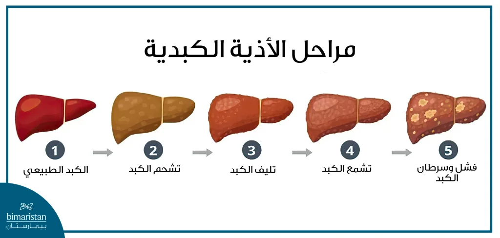 صورة توضح مراحل الأذية الكبدية التي تستوجب علاج تليف الكبد