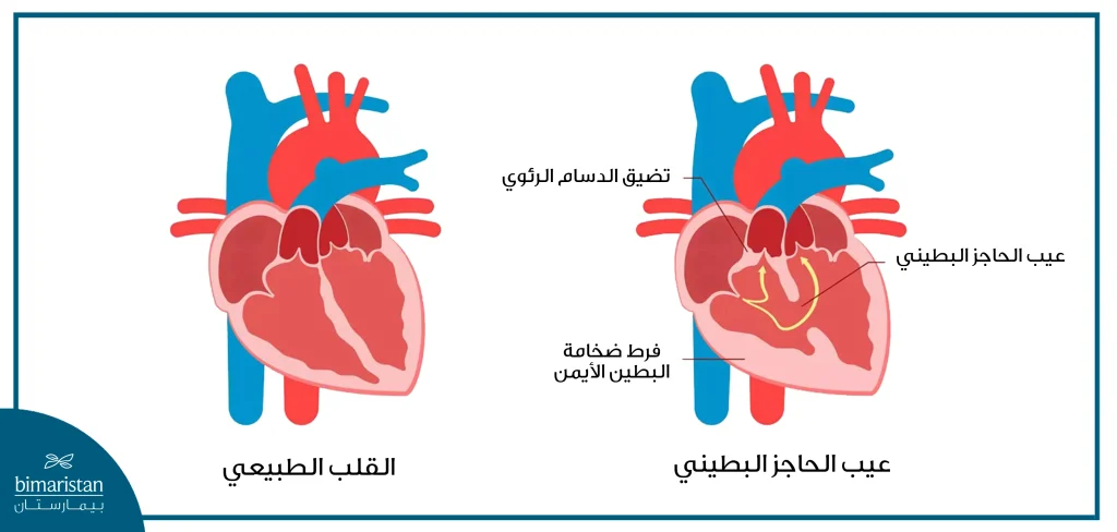 يتميز عيب الحاجز البطيني عن القلب الطبيعي بوجود ثقب يمر الدم من خلاله قد يترافق مع تضيق الدسام الرئوي وفرط ضخامة البطين الأيمن