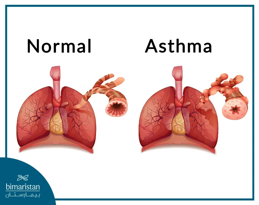 Image Showing Bronchial Constriction In An Asthmatic Patient Compared To A Normal Person Without Asthma