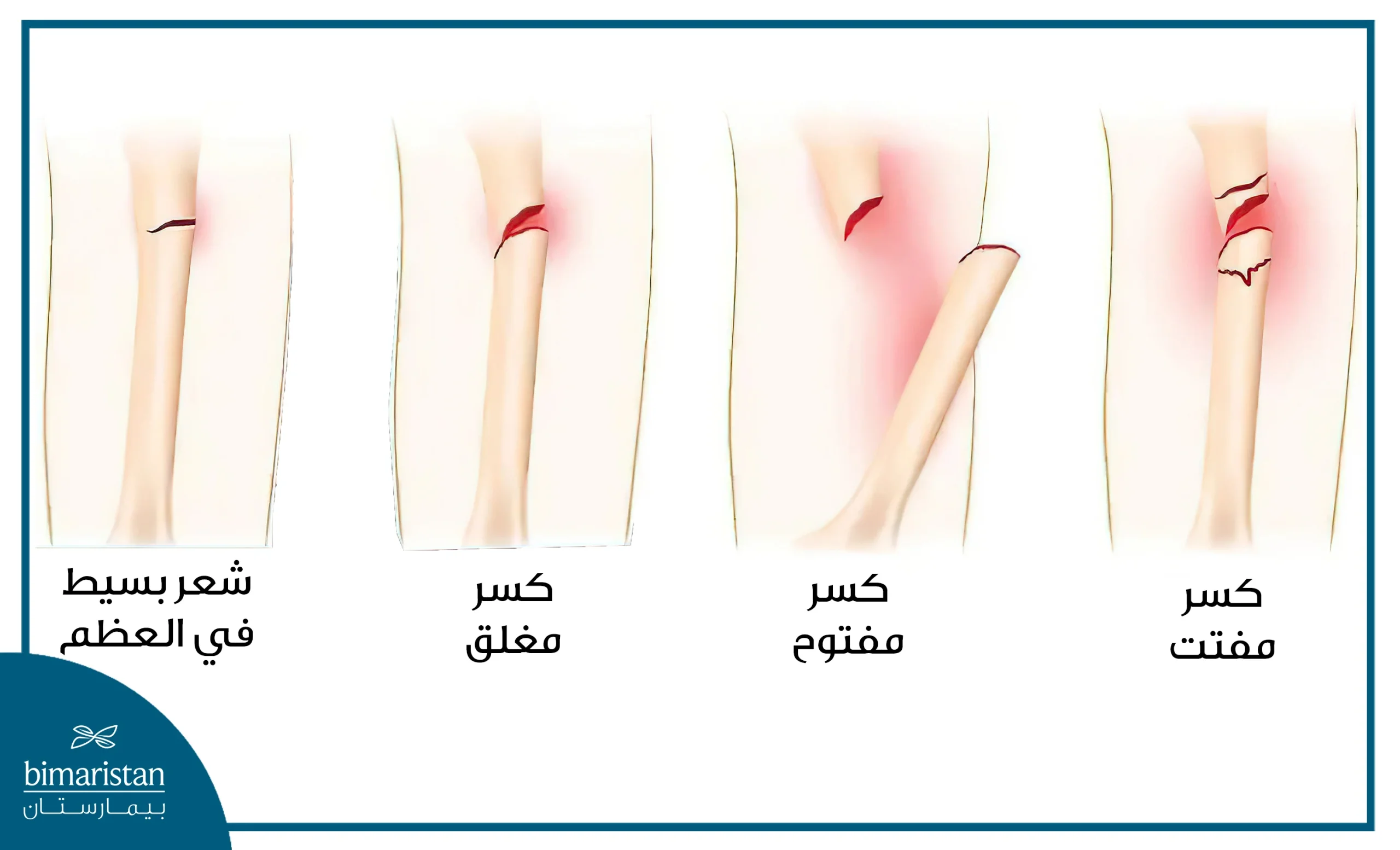 أنواع كسور الركبة وأشكالها